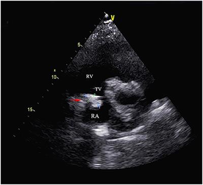 Case report: A primary calcified cardiac mass in right atrium partially obstructs the tricuspid valve in a patient on hemodialysis